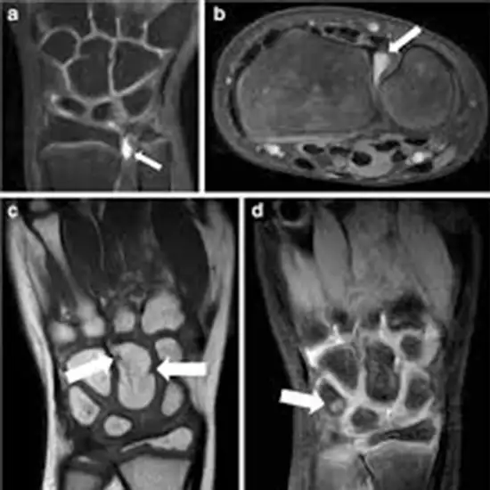 MRI Both Wrist Joint